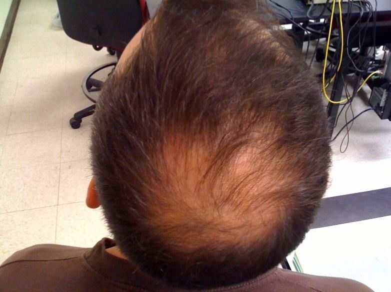 Hair from a 3D printer There’s hope for the bald